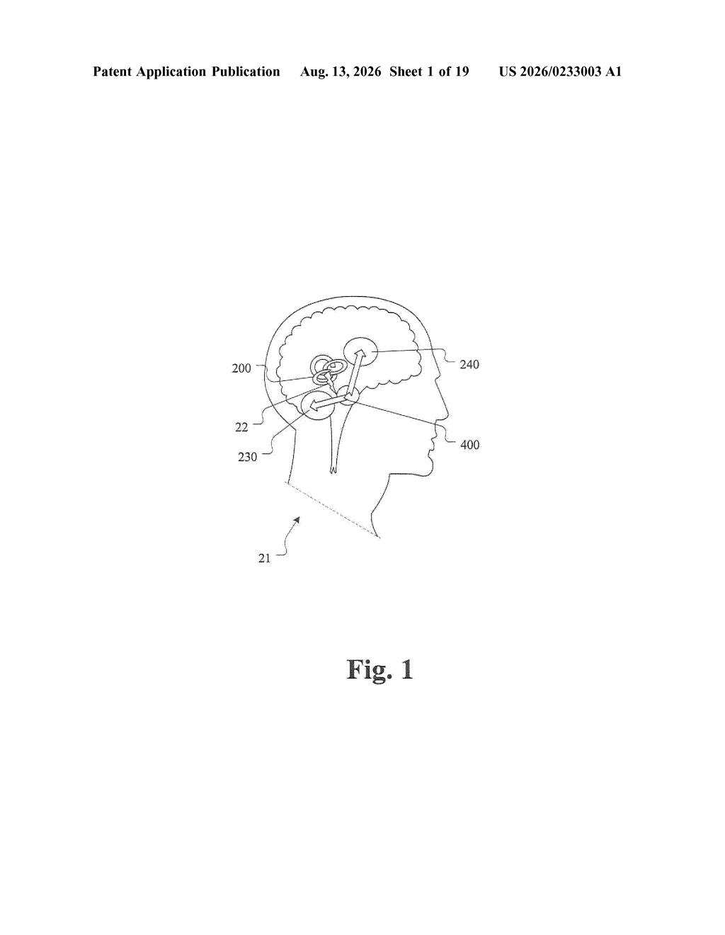 Profile view of a human head showing the motion stimulation device positioned near the inner ear. Drawing from patent filing US 2026/0233003 A1.